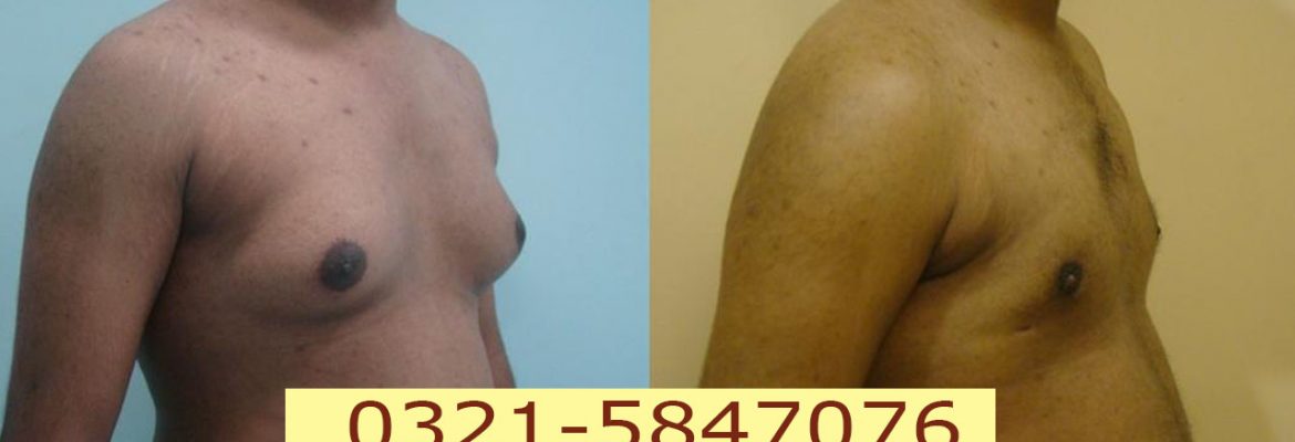 Male boobs reduction surgery in Lahore