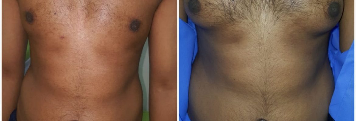 Men boobs reduction surgery in Lahore