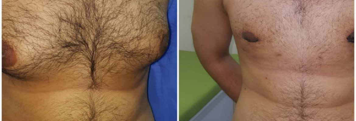 Dr Amin top Gynecomastia in Lahore