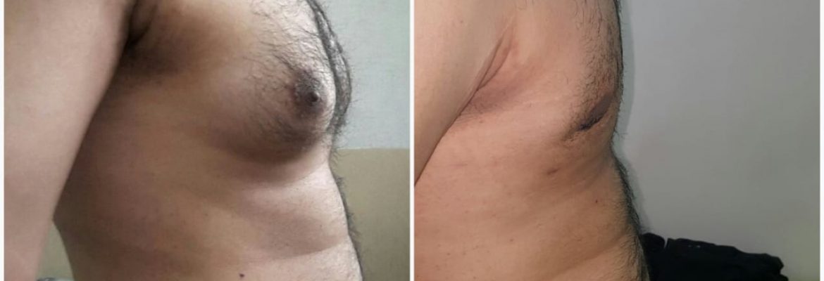 top gynecomastia surgeon pakistan