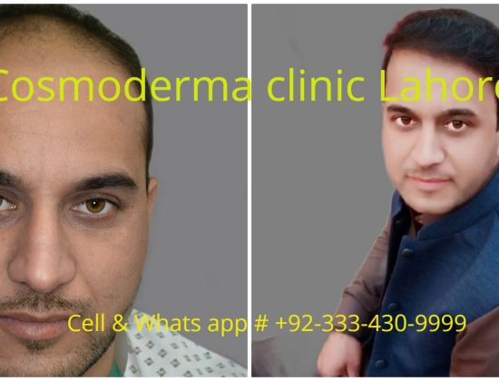 Cheap hair transplant clinic Lahore Pakistan