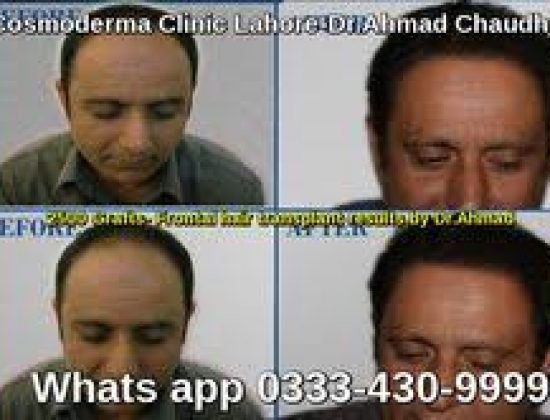 Cheap hair transplant clinic Lahore Pakistan