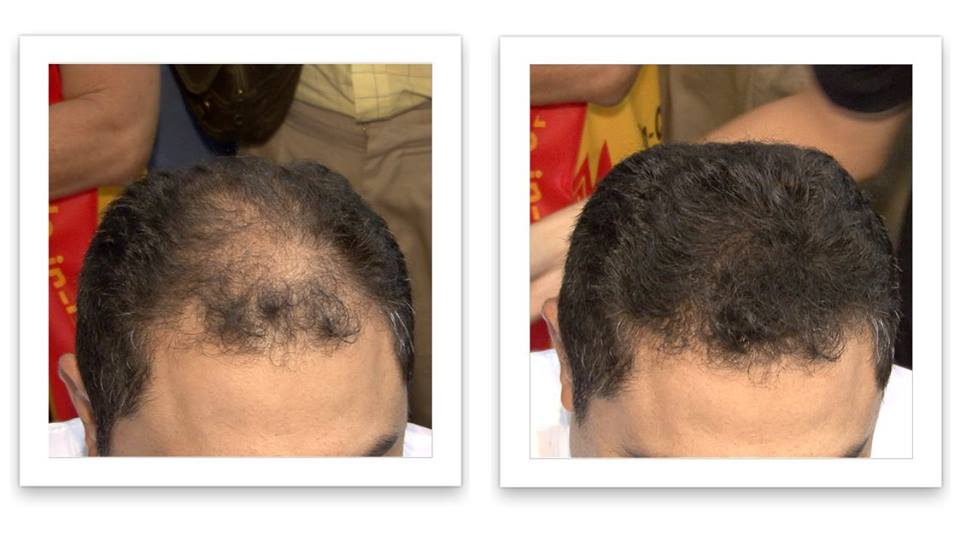Caboki Hair Fiber | Hair Concealer | Bald spot solutions Call or Whatsapp  03005854770 – Pakistan Places