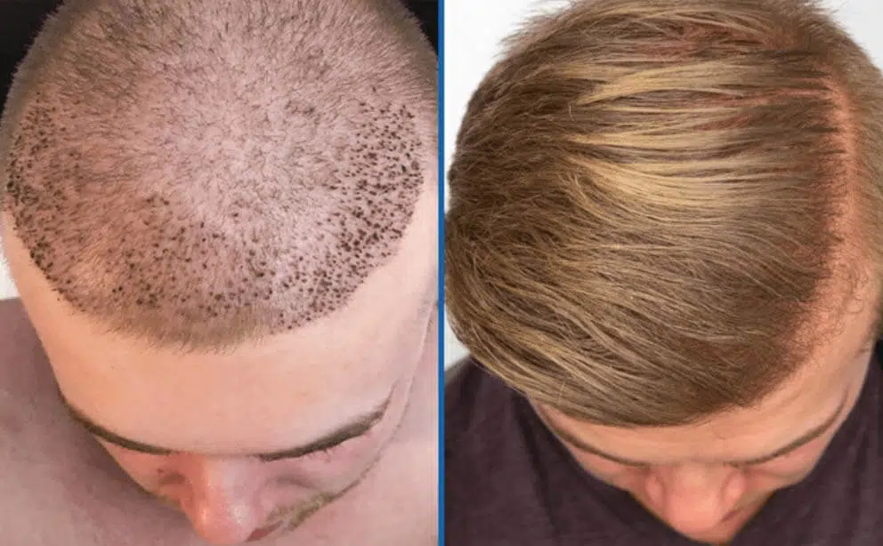 Best Hair transplant in Islamabad
